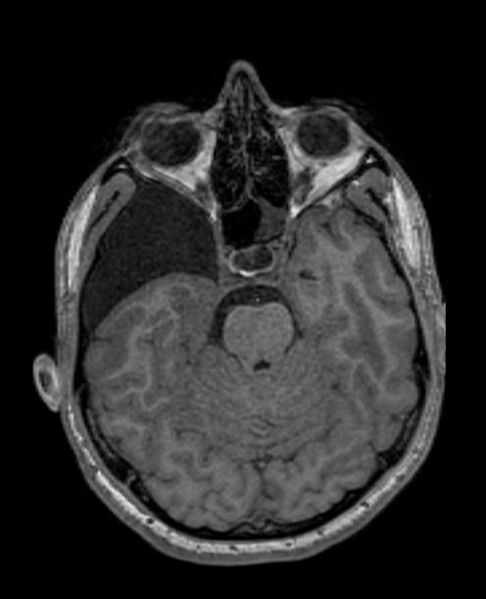 File:Arachnoid cyst- extremely large (Radiopaedia 68741-78451 Axial T1 26).jpg