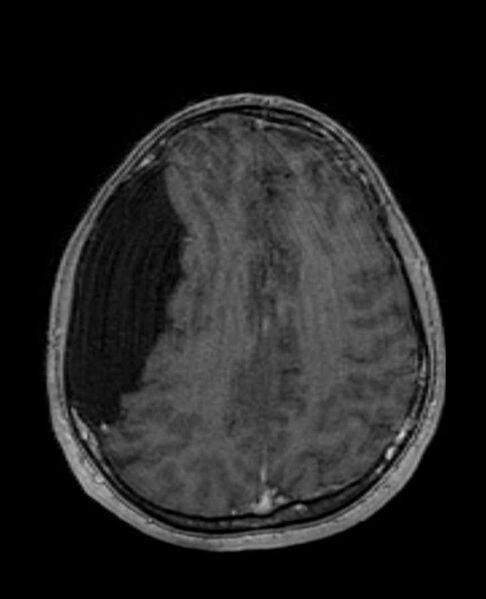 File:Arachnoid cyst- extremely large (Radiopaedia 68741-78451 Axial T1 C+ 57).jpg