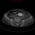 Arachnoiditis ossificans (Radiopaedia 51394-57136 Axial bone window 32).jpg