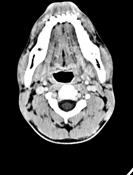 File:Arrow injury to the face (Radiopaedia 73267-84011 Axial C+ delayed 19).jpg