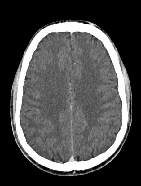 File:Arrow injury to the face (Radiopaedia 73267-84011 Axial C+ delayed 63).jpg