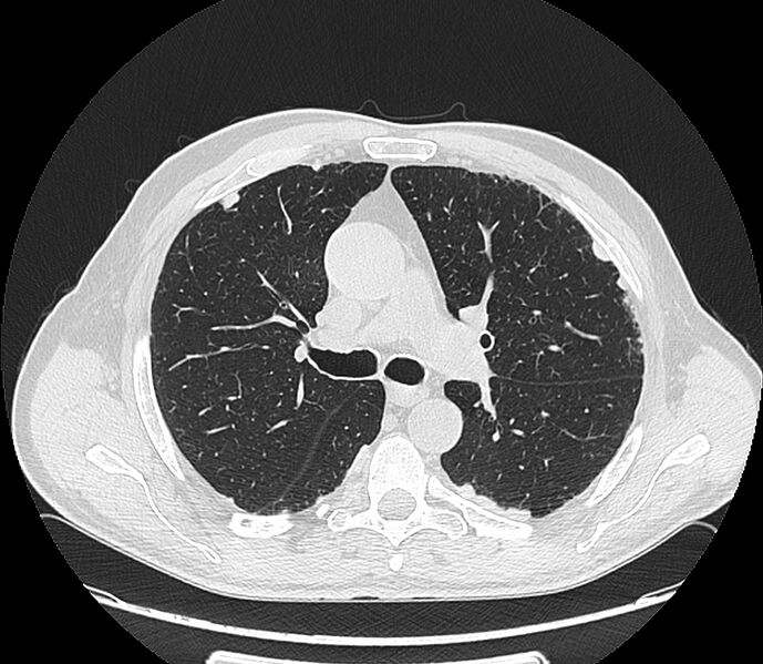 File:Asbestos pleural placques (Radiopaedia 57905-64872 Axial lung window 103).jpg