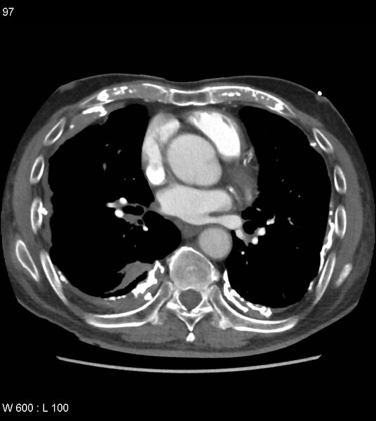 File:Asbestos related lung and pleural disease (Radiopaedia 14377-14301 D 33).jpg