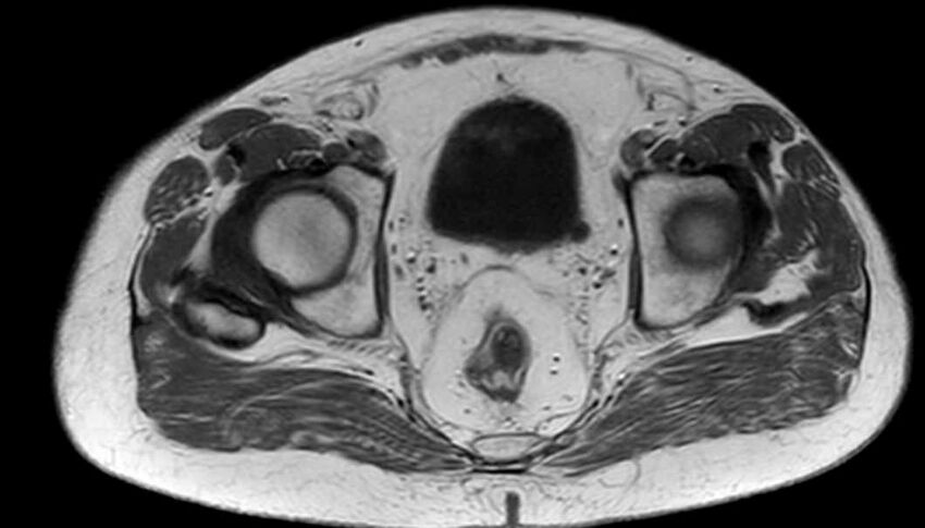 Atypical lipomatous tumor - thigh (Radiopaedia 68975-78734 Axial T1 96).jpg