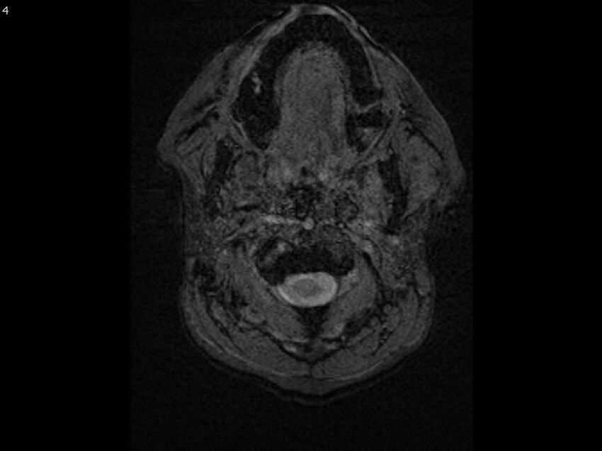 Atypical meningioma - intraosseous (Radiopaedia 64915-74572 Axial SWI 4).jpg