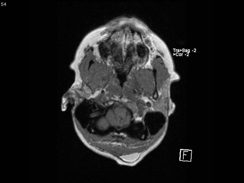 Atypical meningioma - intraosseous (Radiopaedia 64915-74572 Axial T1 54).jpg