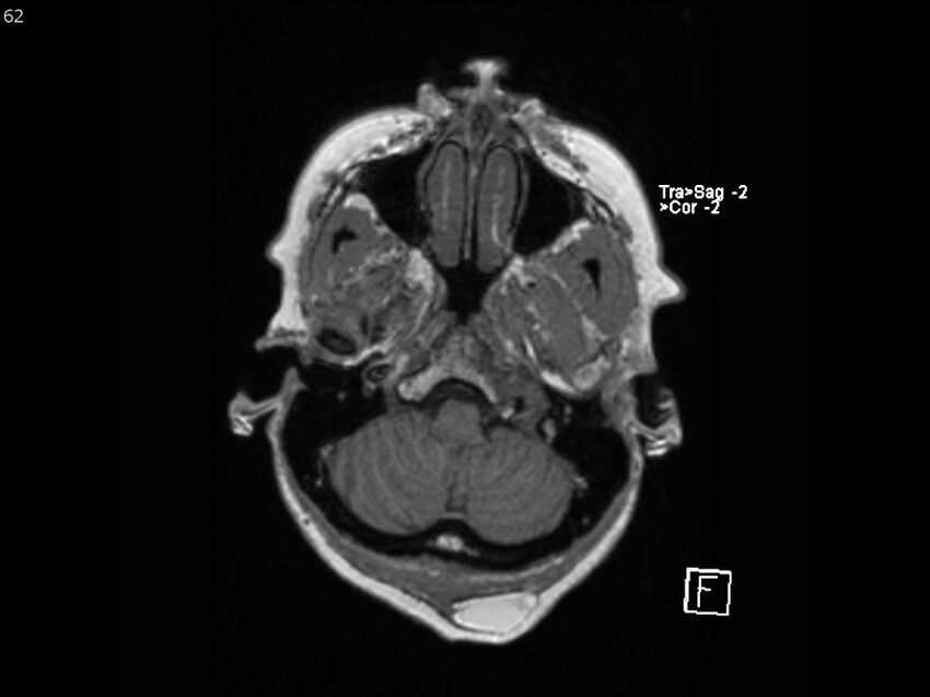 Atypical meningioma - intraosseous (Radiopaedia 64915-74572 Axial T1 62).jpg