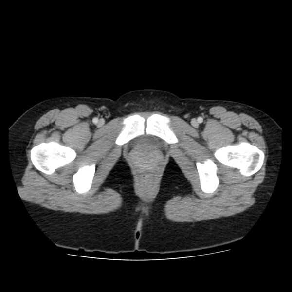 File:Autosomal dominant polycystic kidney disease (Radiopaedia 23061-23093 C 74).jpg