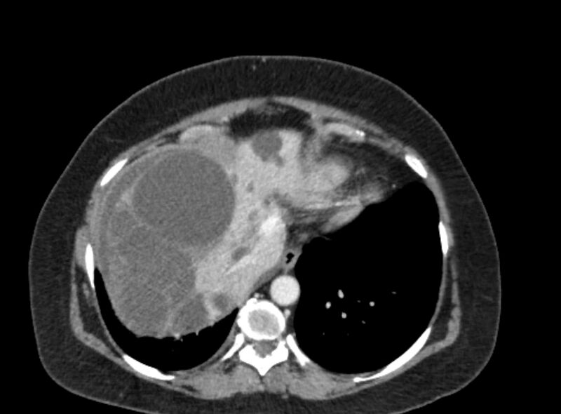 File:Autosomal dominant polycystic kidney disease (Radiopaedia 57124-64017 A 20).jpg