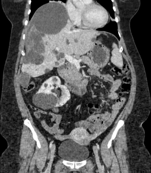 File:Autosomal dominant polycystic kidney disease (Radiopaedia 57124-64017 B 33).jpg