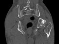 Avascular necrosis of the left hip (Radiopaedia 75068-86125 Coronal bone window 71).jpg