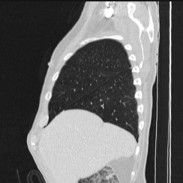 File:Azygos lobe (Radiopaedia 38259-40275 lung window 19).jpg