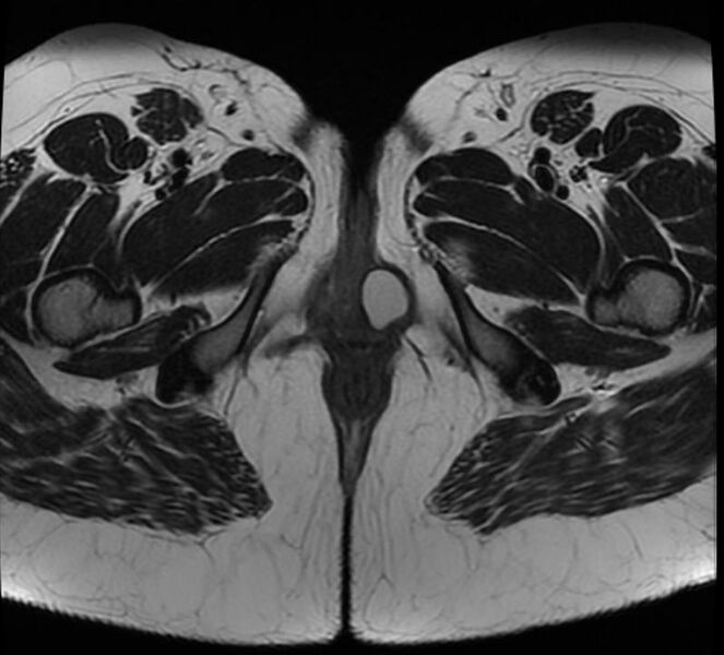 File:Bartholin gland cyst (Radiopaedia 11232-11597 Axial 1).jpg