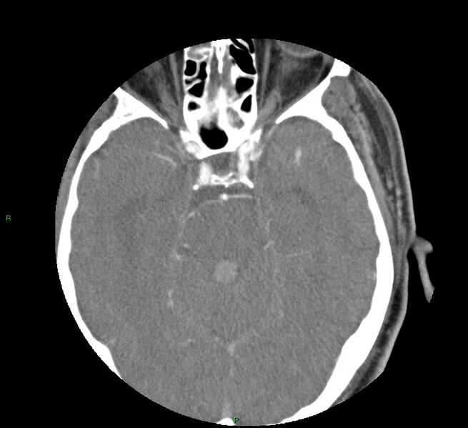 File:Basal ganglia hemorrhage (Radiopaedia 58763-65985 D 70).jpg