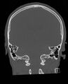 Base of skull fracture with bilateral Le Fort fractures (Radiopaedia 47094-51638 Coronal bone window 35).jpg