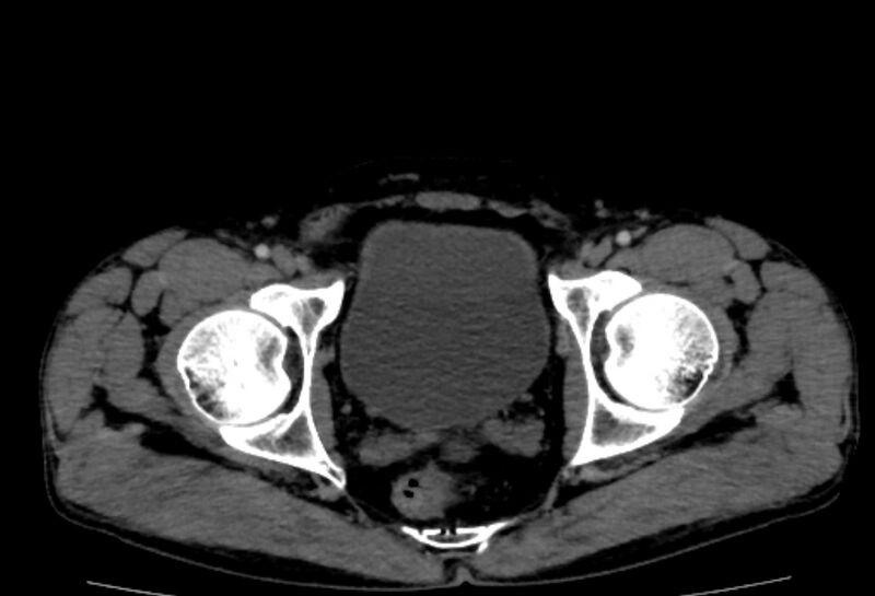 File:Behçet's disease. abdominal vasculitis (Radiopaedia 55955-62570 Axial 68).jpg