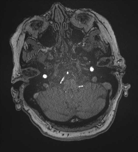 File:Bilateral fetal posterior communicating arteries (Radiopaedia 41286-44102 Axial MRA 24).png