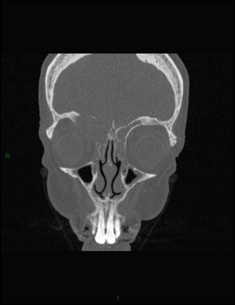 File:Bilateral frontal mucoceles (Radiopaedia 82352-96454 Coronal 102).jpg