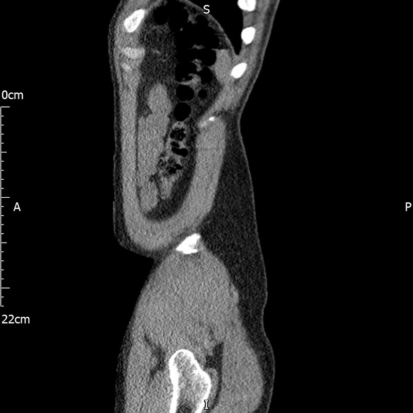 Bilateral medullary nephrocalcinosis with ureteric calculi (Radiopaedia 71269-81569 C 17).jpg