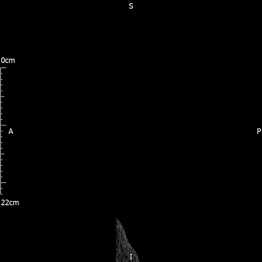 Bilateral medullary nephrocalcinosis with ureteric calculi (Radiopaedia 71269-81569 C 2).jpg