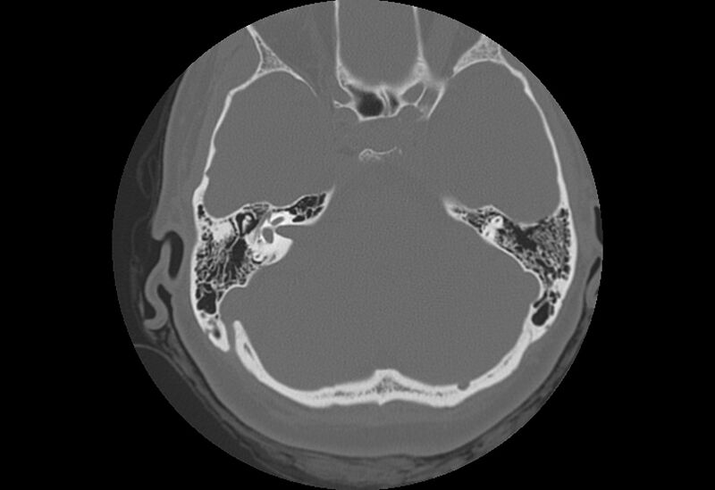 File:Bilateral otospongiosis (Radiopaedia 35447-36940 Axial bone window 36).jpg
