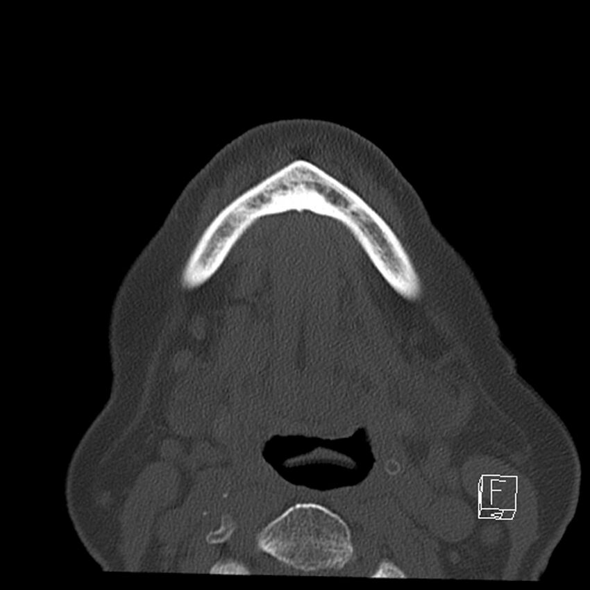 Bilateral palatine tonsilloliths on OPG and CT (Radiopaedia 75167-86247 Axial bone window 55).jpg