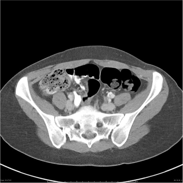 File:Bilateral ureteritis and cystitis (Radiopaedia 25340-25594 A 56).jpg