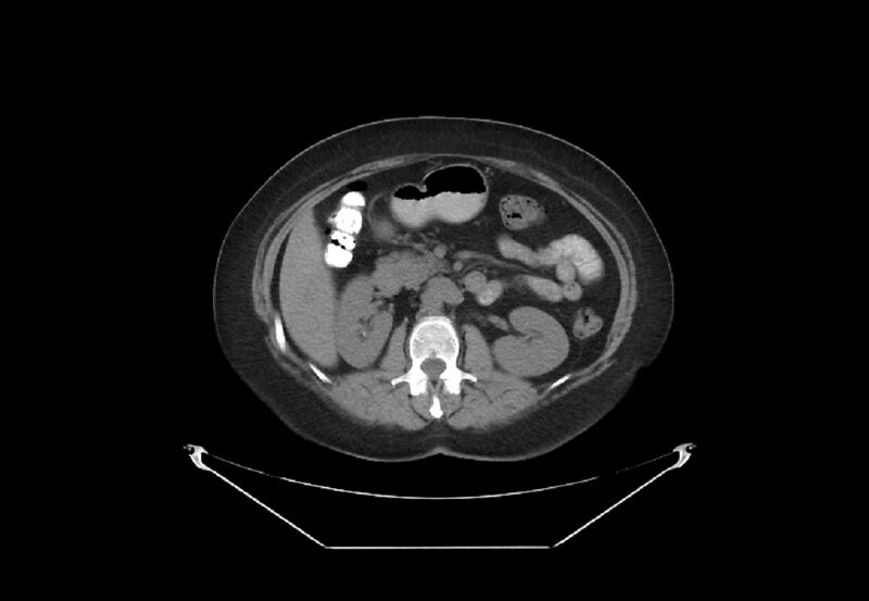 File:Bilateral urolithiasis with incidentally detected splenic artery aneurysm and left inferior vena cava (Radiopaedia 44467-48123 Axial non-contrast 21).jpg