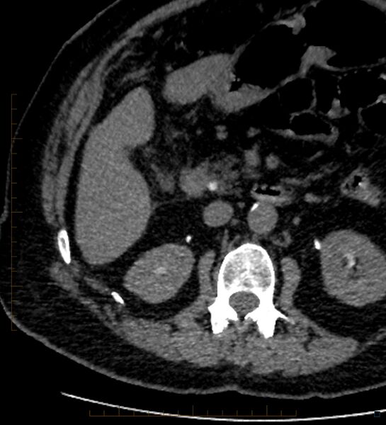 File:Bile leak from accessory duct(s) of Luschka post cholecystectomy (Radiopaedia 40736-43389 A 46).jpg