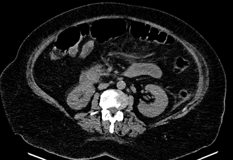 File:Biliary pancreatitis (Radiopaedia 72289-82823 Axial non-contrast 128).jpg