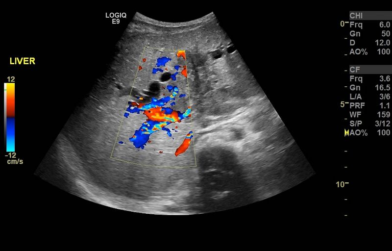 File:Biliary tract embryonal rhabdomyosarcoma (Radiopaedia 51815-57615 C 1).jpg