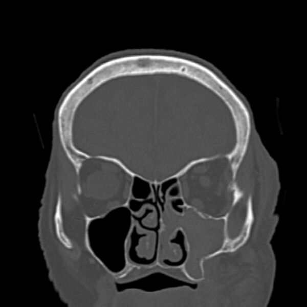 File:Biparietal osteodystrophy (Radiopaedia 46109-50463 Coronal bone window 29).jpg