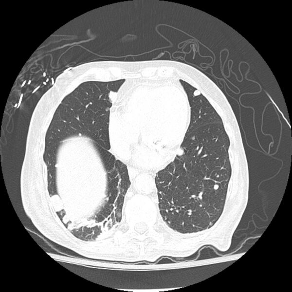 File:Bladder cancer metastases (Radiopaedia 9824-10409 Axial lung window 6).jpg