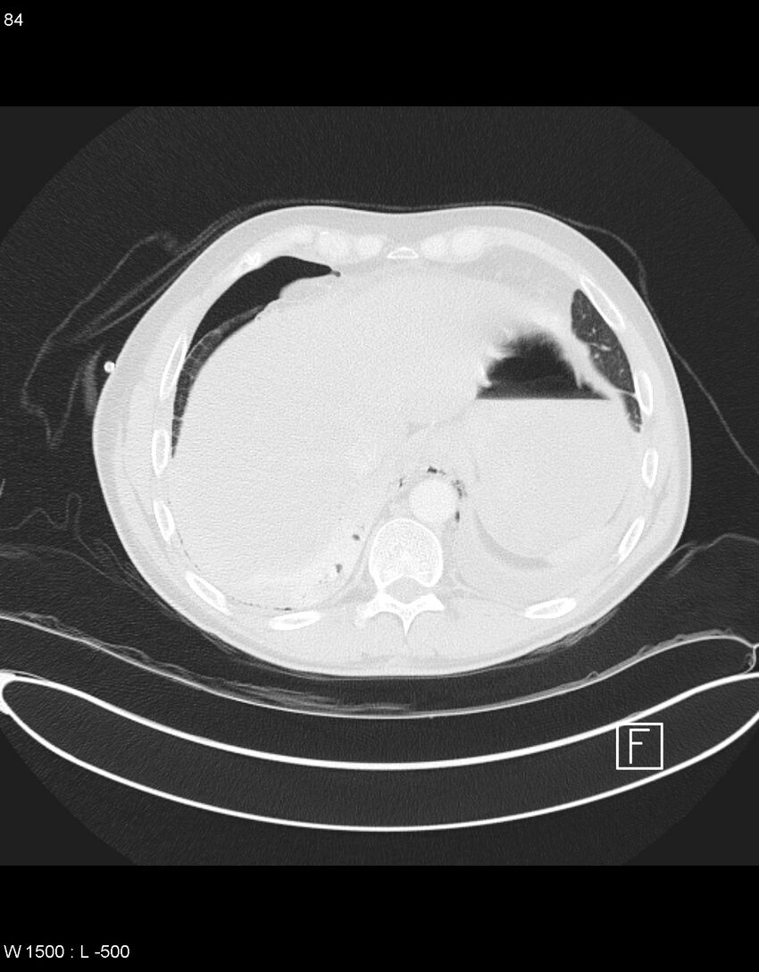 Boerhaave syndrome with tension pneumothorax (Radiopaedia 56794-63605 Axial lung window 41).jpg