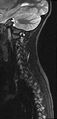 Brachial plexus birth palsy (Radiopaedia 68118-77604 Sagittal T2 11).jpg