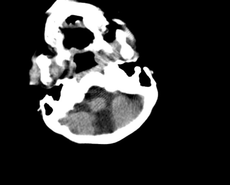 File:Brachycephaly (bi-coronal and bi-lambdoid synostosis) (Radiopaedia 55048-61413 Axial non-contrast 8).jpg