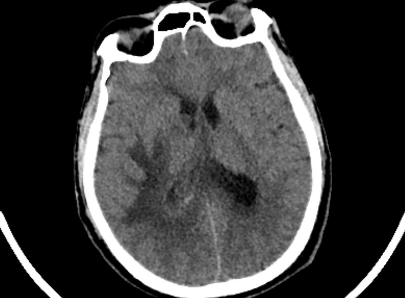 File:Brain abscess complicated by intraventricular rupture and ventriculitis (Radiopaedia 82434-96575 Axial non-contrast 49).jpg
