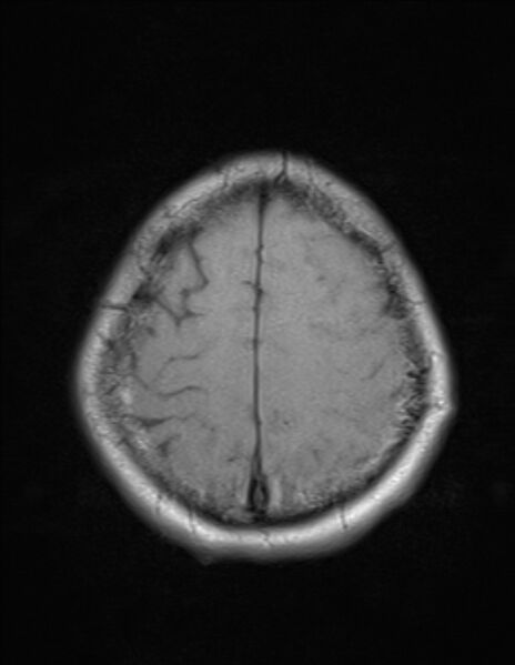 File:Brain abscess with ventriculitis (Radiopaedia 85703-101495 Axial T1 23).jpg