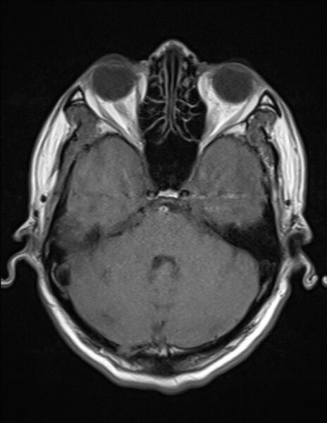 File:Brain abscess with ventriculitis (Radiopaedia 85703-101495 Axial T1 7).jpg