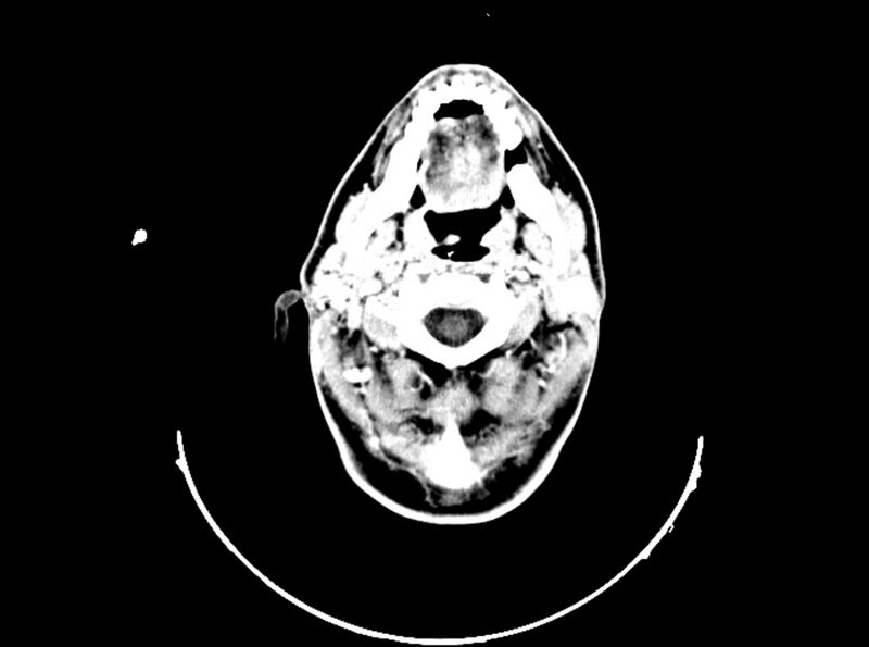 File:Brain injury by firearm projectile (Radiopaedia 82068-96088 B 50).jpg