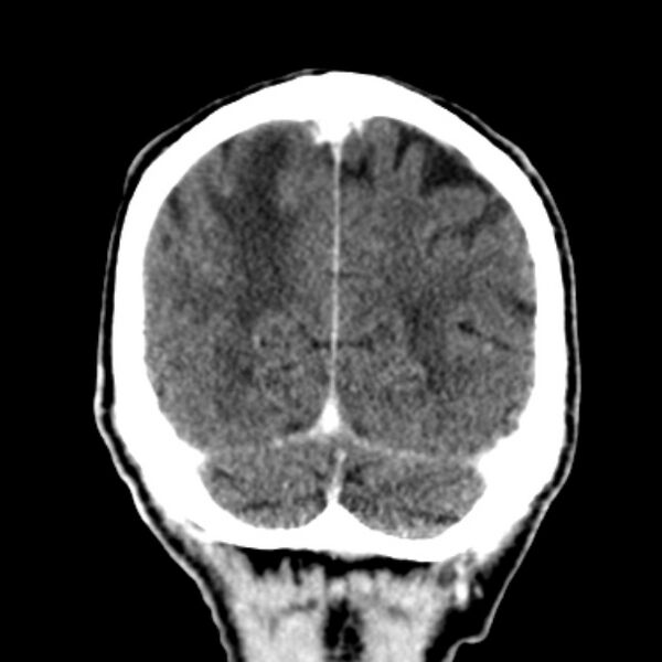 File:Brain metastases from lung cancer (Radiopaedia 27849-28092 Coronal C+ delayed 55).jpg