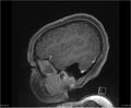 Brainstem glioma (Radiopaedia 21819-21775 D 36).jpg