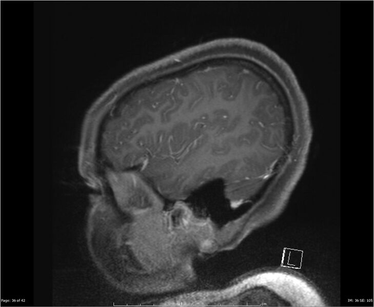 File:Brainstem glioma (Radiopaedia 21819-21775 D 36).jpg