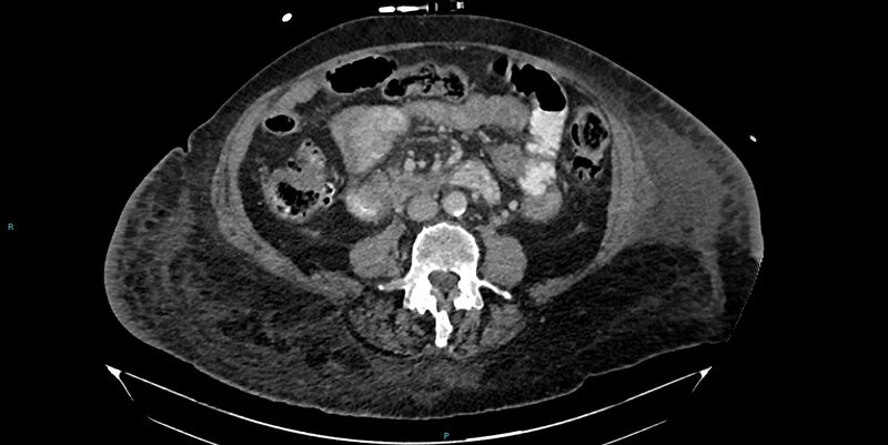 File:Breast cancer pelvic bony metastases (Radiopaedia 84470-99824 Axial bone window 6).jpg