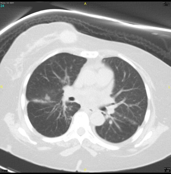 File:Breast primary with lung and bone metastases (Radiopaedia 40620-43228 Axial lung window 24).jpg