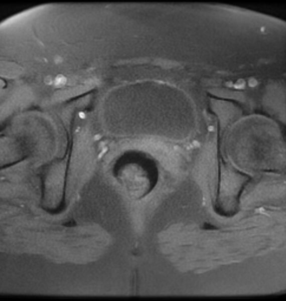 File:Broad ligament leiomyoma (Radiopaedia 81634-95516 Axial T1 fat sat 21).jpg