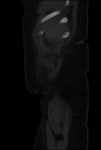 File:Brown tumors compressing the spinal cord (Radiopaedia 68442-77988 H 5).jpg