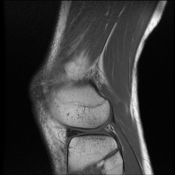 File:Bucket-handle meniscus tear (Radiopaedia 65700-74809 Sagittal T1 18).jpg