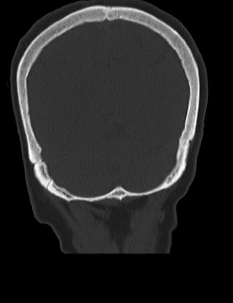 File:Burnt-out meningioma (Radiopaedia 51557-57337 Coronal bone window 44).jpg