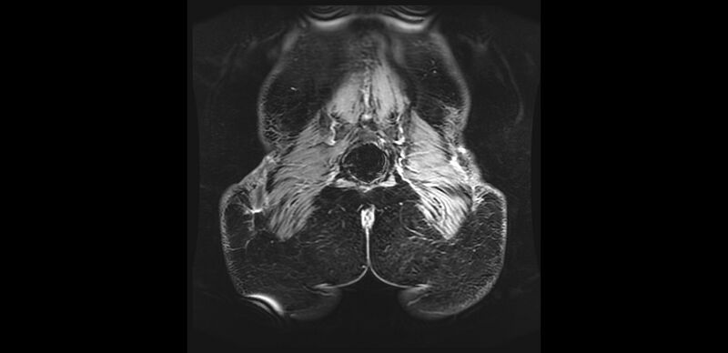 File:Buttock filler complications (Radiopaedia 63497-72115 Coronal T1 C+ 50).jpg